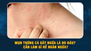 mụn trứng cá gây ngứa