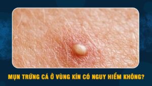 Mụn trứng cá ở vùng kín