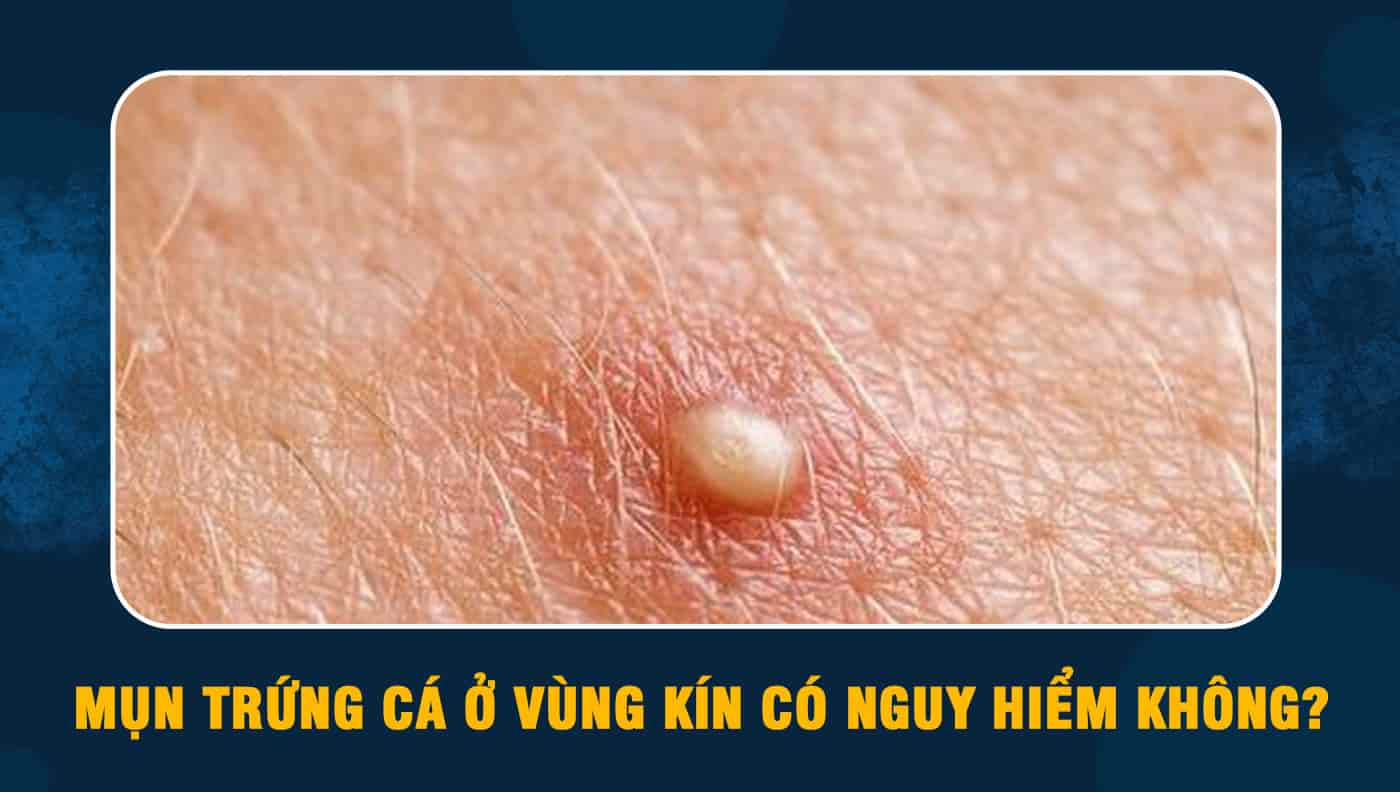 Mụn trứng cá ở vùng kín: Nguyên nhân, triệu chứng và cách điều trị hiệu quả