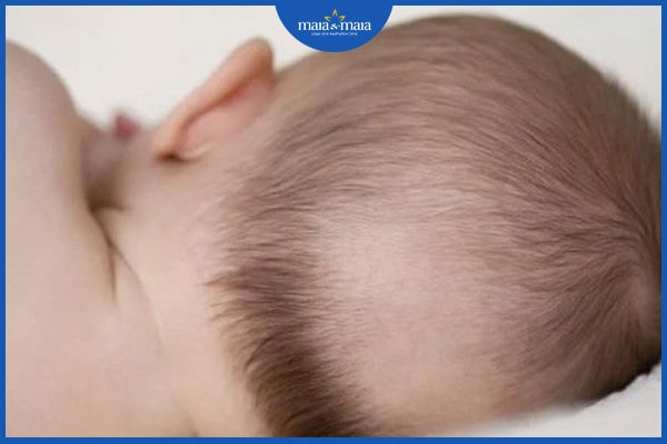 Rụng tóc ở trẻ 3 tháng tuổi