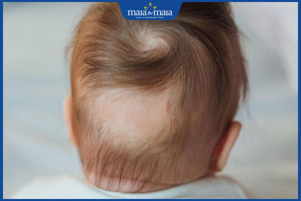 Rụng tóc ở trẻ 3 tháng tuổi có nguy hiểm không? Nguyên nhân là gì? 2 rụng tóc ở trẻ 3 tháng tuổi