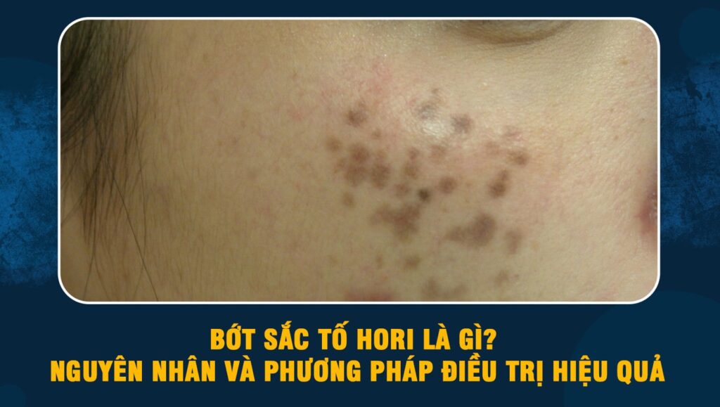 Bớt sắc tố Hori là gì? Nguyên nhân và phương pháp điều trị hiệu quả 1 Bớt sắc tố Hori