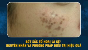 Bớt sắc tố Hori