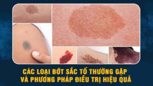 các loại bớt sắc tố