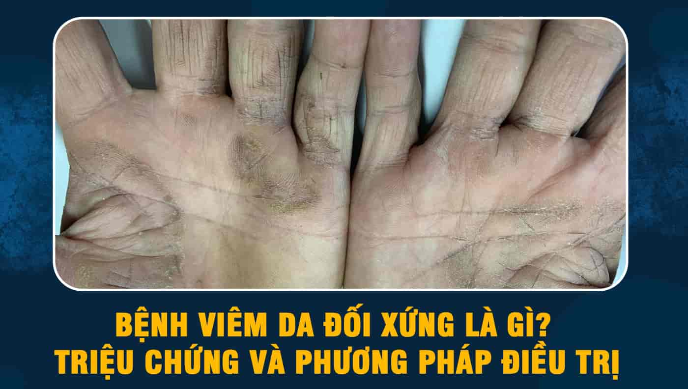 Bệnh viêm da đối xứng là gì? Triệu chứng và phương pháp điều trị