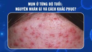 mụn ở từng độ tuổi