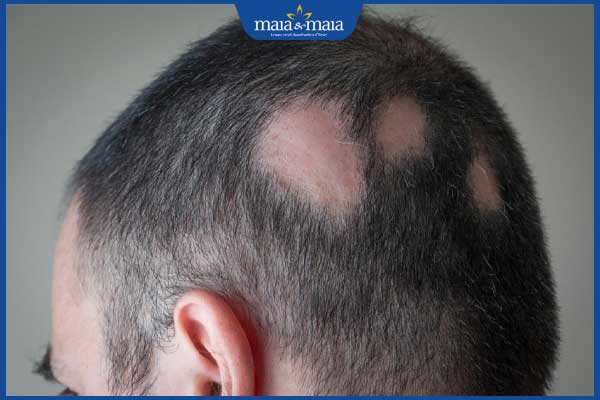 Cấy tóc FUE giá bao nhiêu? Lưu ý trước và sau khi thực hiện 3 rụng tóc từng vùng