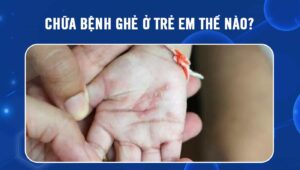 chữa bệnh ghẻ ở trẻ em