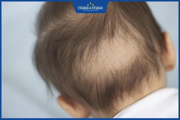 Các loại rụng tóc ở trẻ em