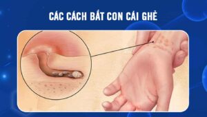 cách bắt con cái ghẻ