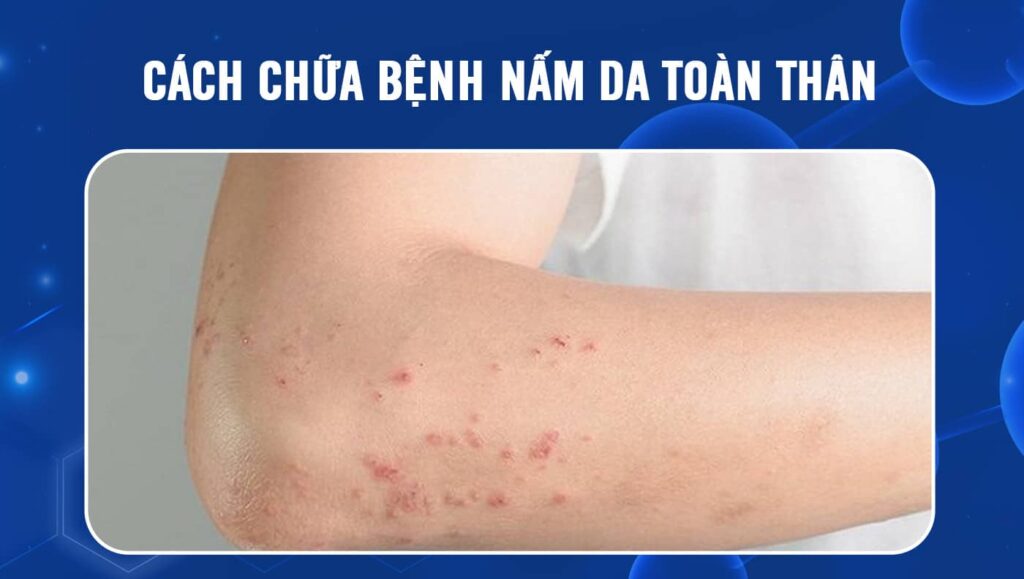 Thuốc trị nấm da toàn thân: Giải pháp hiệu quả cho sức khỏe làn da