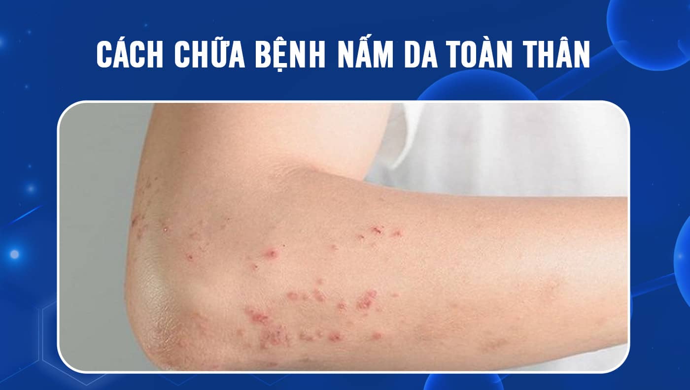 Hình ảnh nấm da toàn thân: Dấu hiệu, nguyên nhân và hướng dẫn điều trị chi tiết