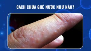 cách chữa ghẻ nước như nào