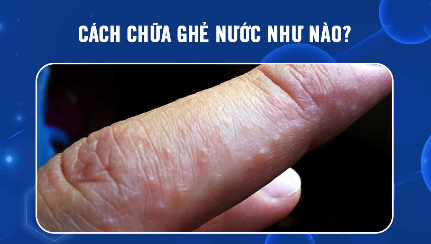 Cách chữa ghẻ nước như nào? - Phòng khám da liễu Maia&Maia