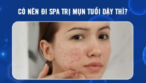 Có nên đi spa trị mụn tuổi dậy thì