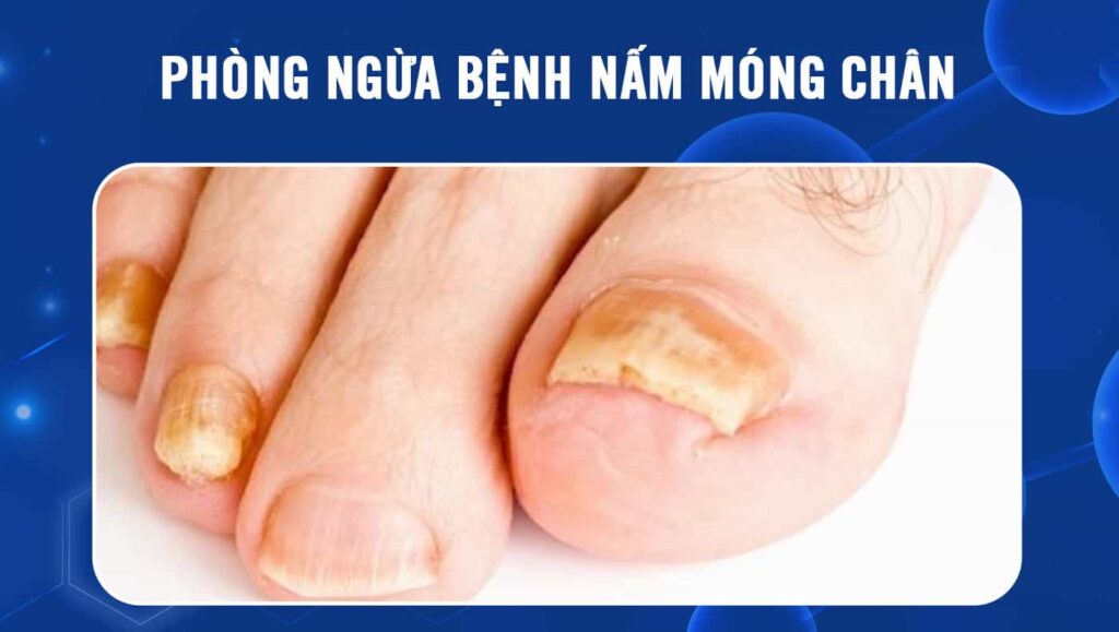 phòng ngừa bệnh nấm móng chân