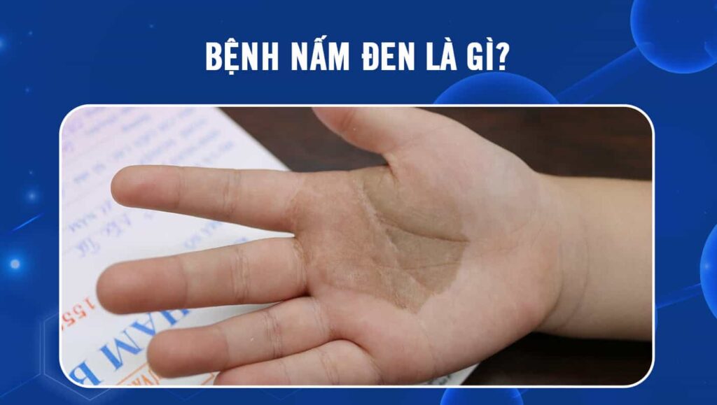Bệnh nấm đen là gì? 1 Bệnh nấm đen