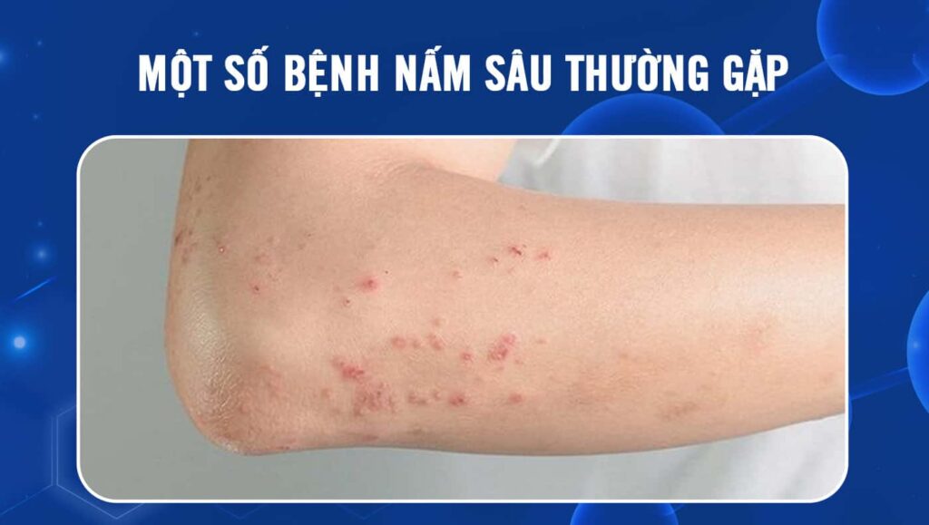 bệnh nấm sâu