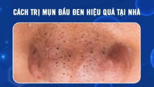 cách trị mụn đầu đen