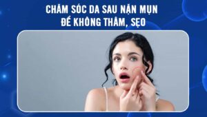 chăm sóc da sau nặn mụn