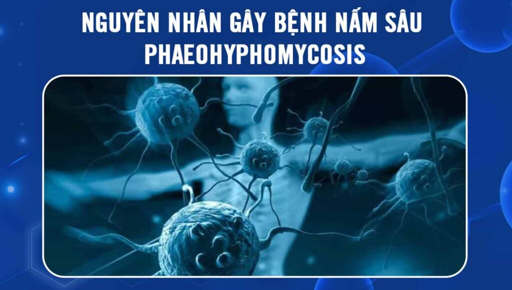 nguyên nhân gây bệnh nấm sâu