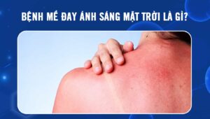 Bệnh mề đay ánh sáng mặt trời
