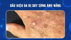 dày sừng ánh nắng