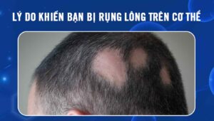 Rụng lông trên cơ thể