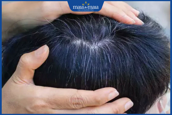 tình trạng tóc bạc sớm ở nam giới