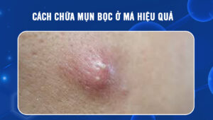 cach-chua-mun-boc-o-ma