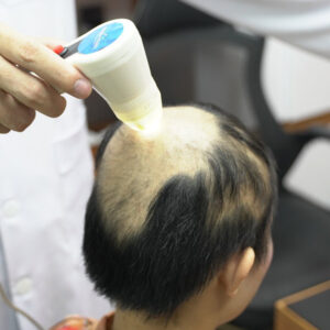 tri rung toc hoi dau 1