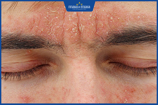 Ở người lớn, viêm da dầu chủ yếu tập trung ở vùng mặt