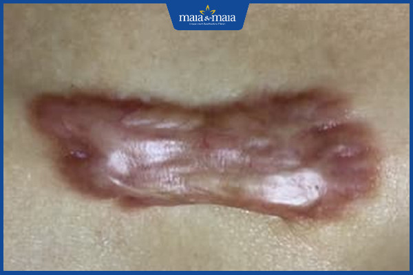 Công nghệ Maitrix Scar được áp dụng thực hiện với trường hợp sẹo lồi, sẹo xấu