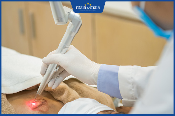 Công nghệ Maitrix Scar áp dụng trong điều trị sẹo lồi, sẹo xấu