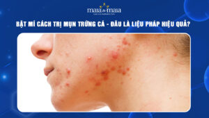 cách trị mụn trứng cá