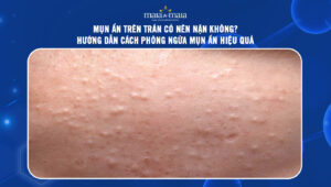 mụn ẩn trên trán thum