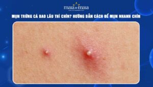 mụn trứng cá bao lâu thì chín