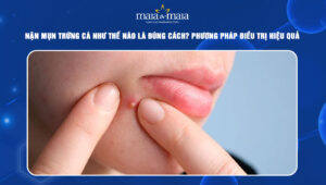 nặn mụn trứng cá thum