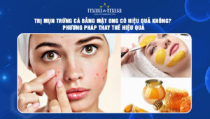 trị mụn trứng cá bằng mật ong