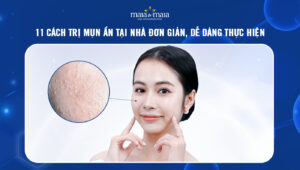 cách trị mụn ẩn tại nhà