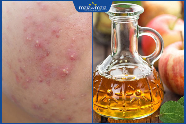 giấm táo trị mụn trứng cá