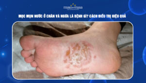 mọc mụn nước ở chân và ngứa