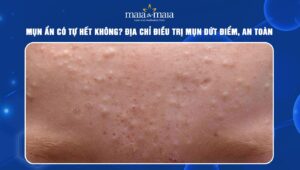 mụn ẩn có tự hết không