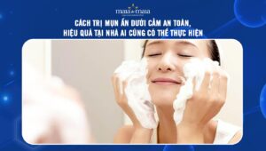 mụn ẩn ở cằm