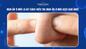 mụn ẩn ở mũi