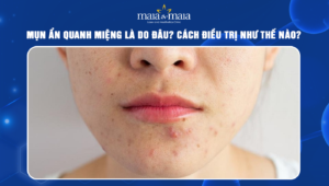 mụn ẩn quanh miệng