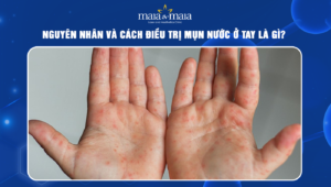 mụn nước ở tay