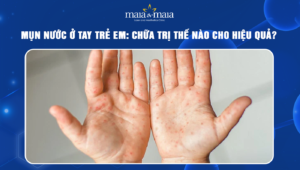 mụn nước ở tay trẻ em