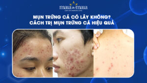 mụn trứng cá có lây không