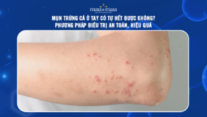 mụn trứng cá ở tay